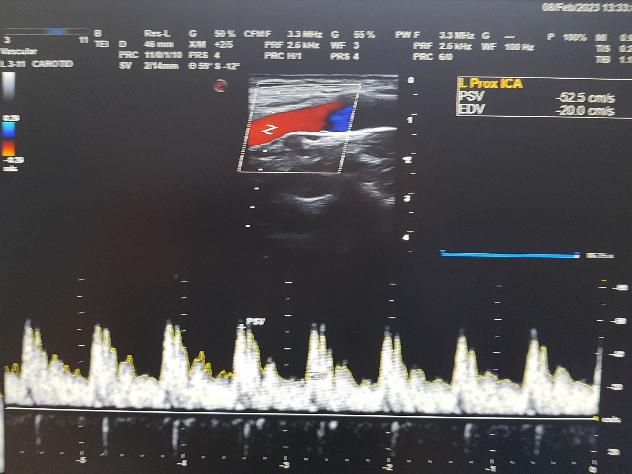 USG doppler tętnic szyjnych i kręgowych